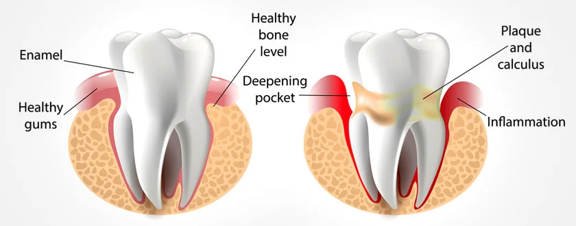 Gum Treatment in Vellore