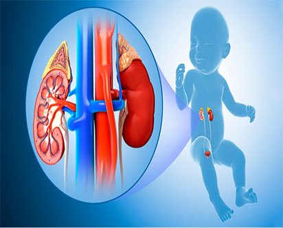 Hydronephrosis Treatment in Vellore